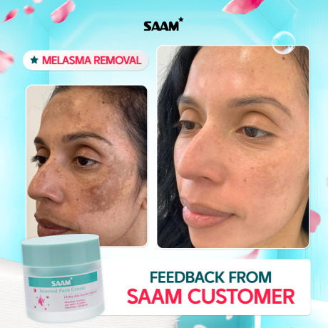 60% Off SAAM Renewal Face Cream for Melasma and Freckles Treatment