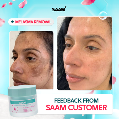 60% Off SAAM Renewal Face Cream for Melasma and Freckles Treatment
