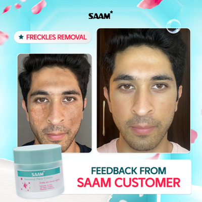 60% Off SAAM Renewal Face Cream for Melasma and Freckles Treatment